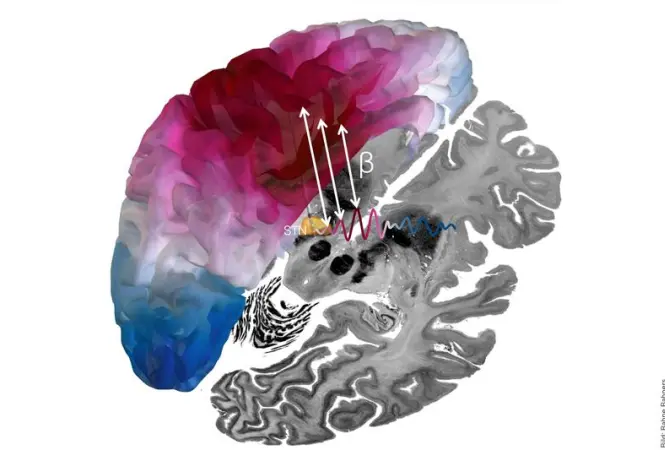 Gehirnnetzwerk zur effektiven Behandlung der Parkinson-Krankheit