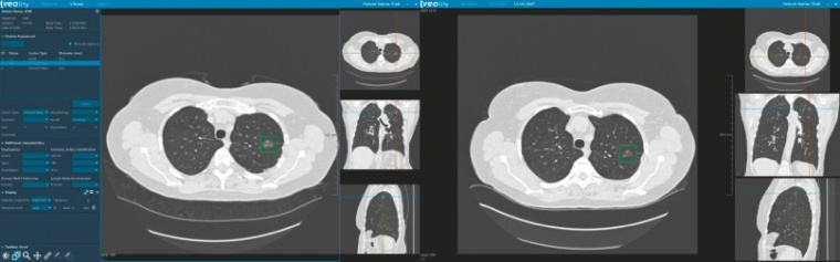 Automatischer Vergleich mit Voraufnahmen und bekannten Läsionen