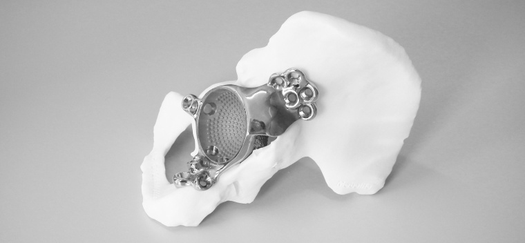3-D-gedrucktes patientenspezifisches Titan-Implant und Hüftmodell Foto:...