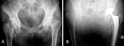 Abb. 6a, b: Röntgenaufnahmen einer 79-jährigen Patientin mit...