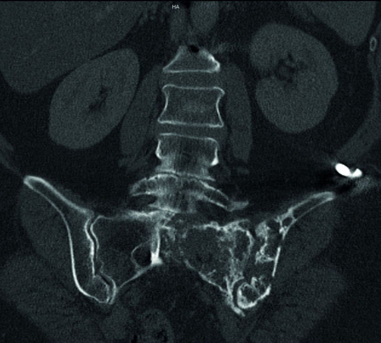 Abb. 4d: Kontroll-CT ein Jahr nach OP und Radiatio mit teilweiser...