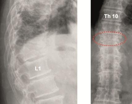 Photo: Palliative Versorgung von Metastasen an Wirbelsäule und Becken