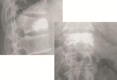 Photo: Palliative Versorgung von Metastasen an Wirbelsäule und Becken