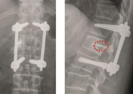 Photo: Palliative Versorgung von Metastasen an Wirbelsäule und Becken