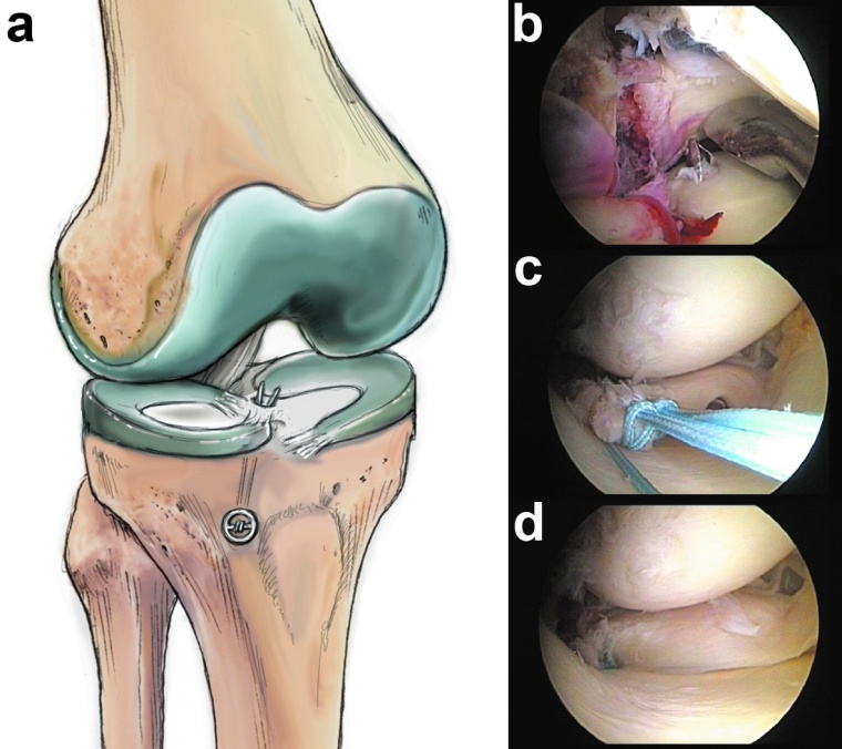 Abb. 1: Refixation der Innenmeniskus-Hinterhornwurzel mittels transtibialer...