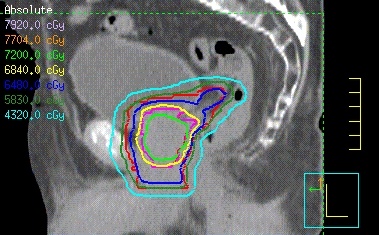 Sagittale Dosisverteilung bei einem Patienten mit Prostatakarzinom. Der Enddarm...
