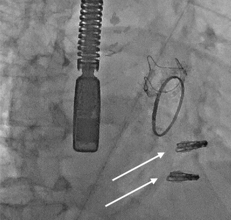 Trikuspidalklappen-Clips (weiße Pfeile) nach der Implantation in der...