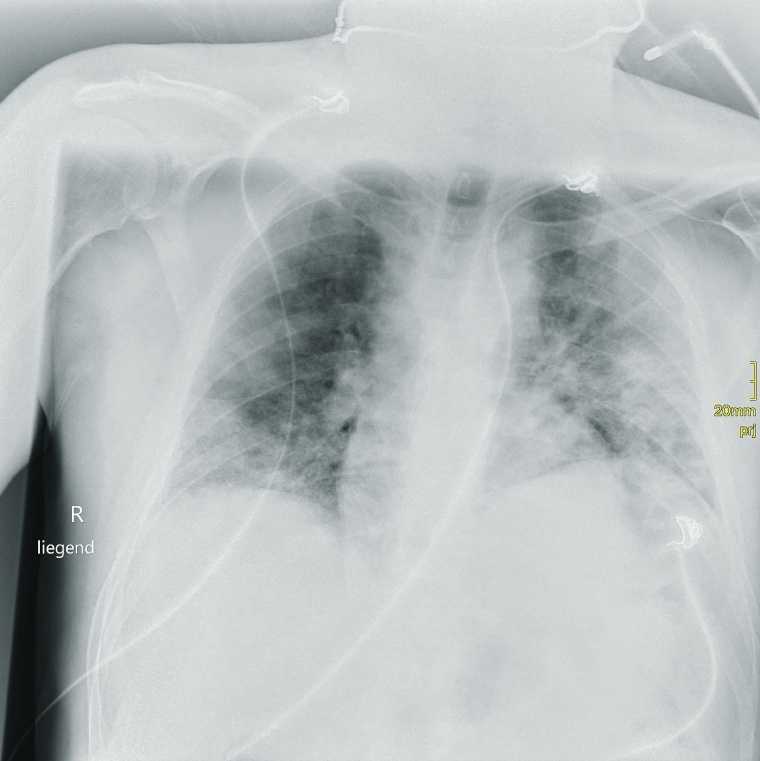 65-jähriger männlicher Patient; Notaufnahme Röntgen Liegendthorax bei...
