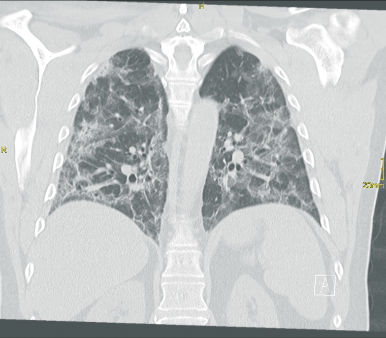 CT-Bestätigung der COVID-19-Pneumonie am gleichen Tag. Foto: Canon