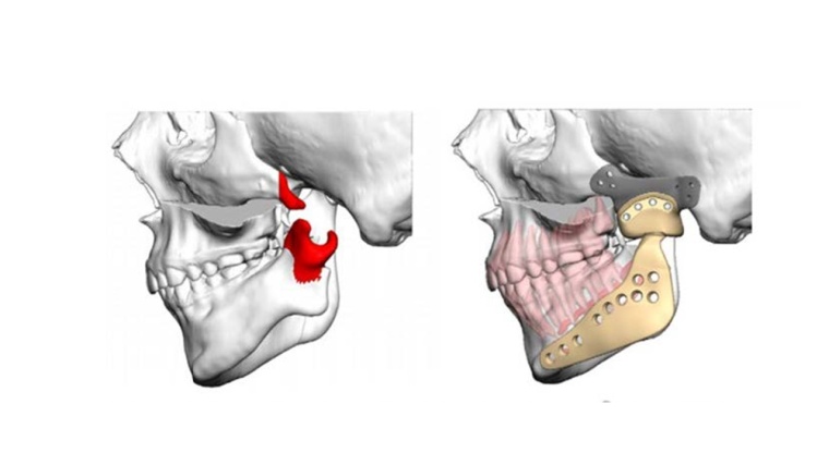 Abb. 2: Virtuelle Planung des alloplastischen Patienten-spezifischen...