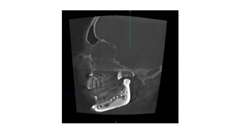 Abb. 3: Intraoperative 3D-Bildgebung nach Implantation des Kiefergelenkersatzes