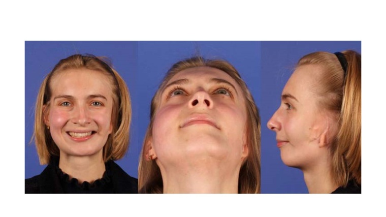 Abb. 4: Klinisches Ergebnis 1 Jahr postoperativ