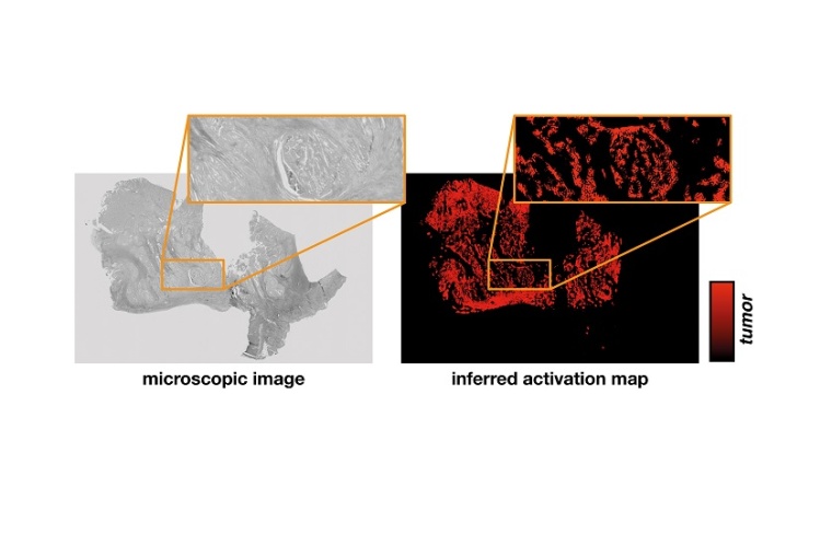 Aus dem mikroskopischen Bild einer Gewebeprobe (links) leitet das neuronale...
