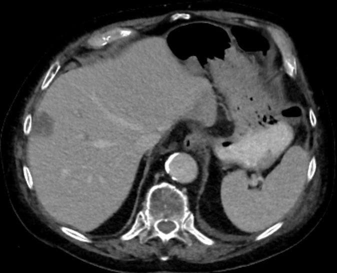 Solitäre Lebermetastase subkapsulär im Segment 8 des rechten Leberlappens,...
