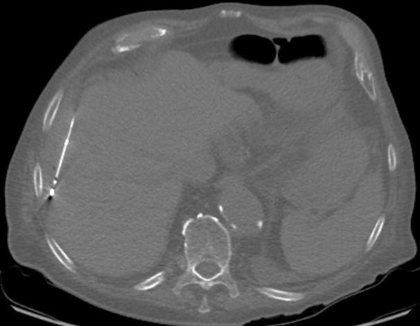 Darstellung der Mikrowellensonde in Position der Lebermetastase, Foto:...