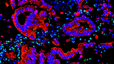 Blick ins Mikroskop: Molekulare Untersuchungen decken auf, wie Krebszellen...