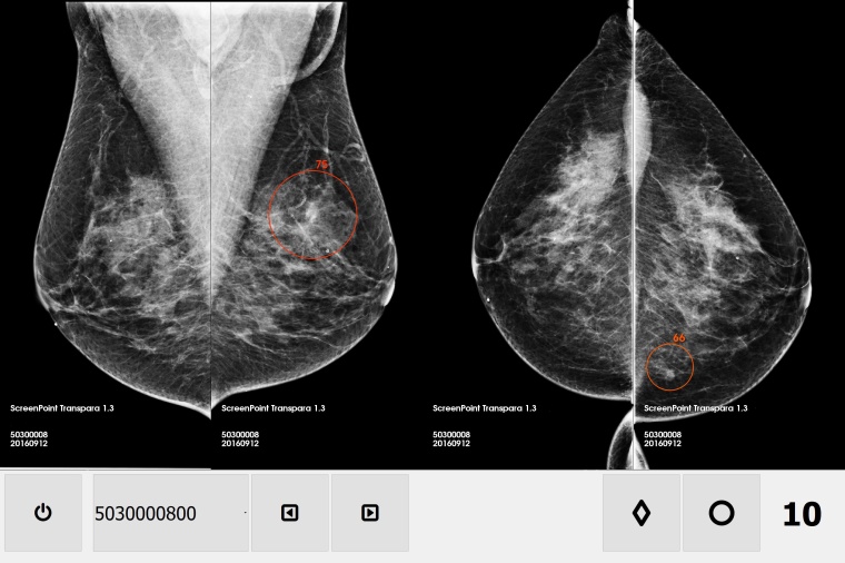 Transpara, die hochwertige Mammographie-Befundungssoftware von ScreenPoint...