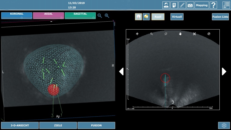 Durch die Fusion des MRT- und Ultraschallbildes wird vor der Probenentnahme ein...