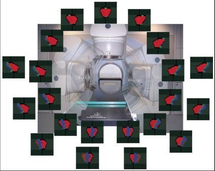 Ein Prostatatumor wird mit zwei Rotationen des Geräts bestrahlt.