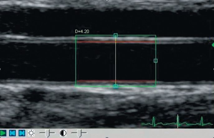 Abb. 1: Computerunterstützte Ultraschallmessung des Durchmessers der A....