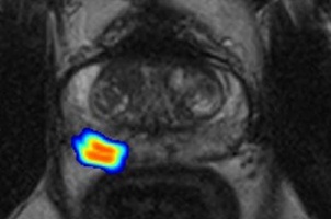 Künstliche Intelligenz kann Radiologen bei der klinischen Befundung von...