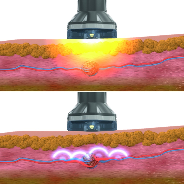 Optoakustische Bildgebung basiert auf Anregung durch Licht und Detektion sowie...