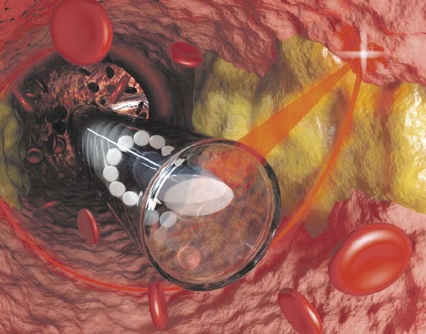 Konzeptzeichnung des Endoskops und der seitlich blickenden, fokussierenden...