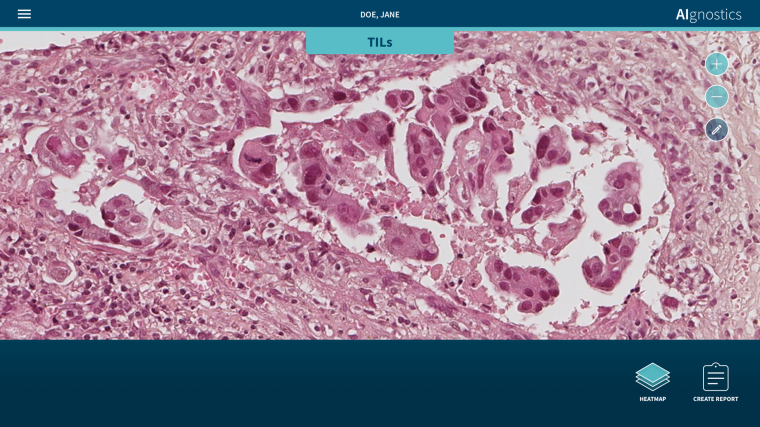Gewebepräparat eines Mammakarzinoms. Grafik: Klauschen/Charité