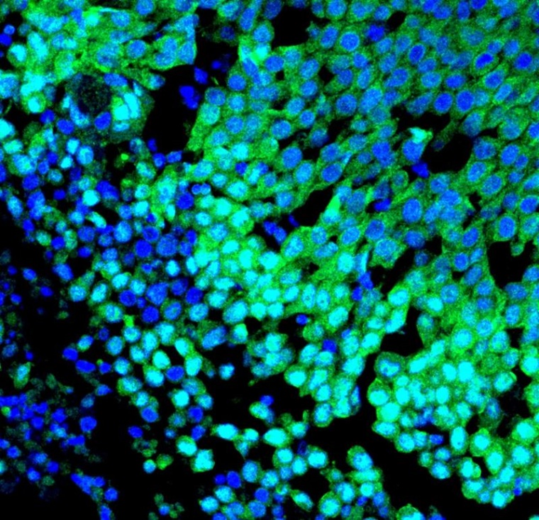 Immunfluoreszenzbild eines basalen Brusttumors mit starker Kernlokalisation des...