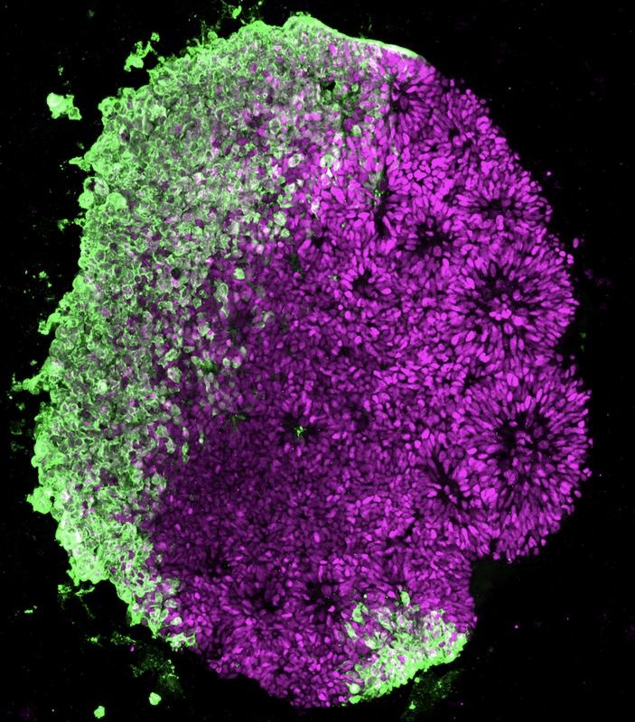 Gehirn-Organoid mit Herpesvirenbefall. Foto: IMBA/Krenn
