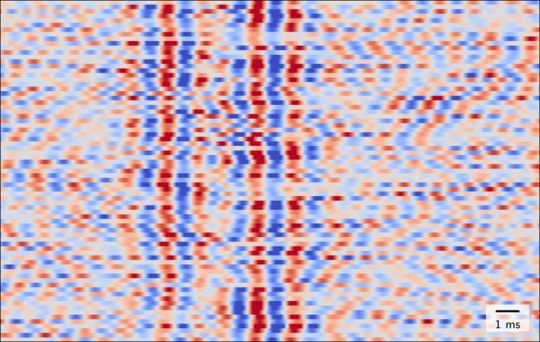 Nichtinvasiv gemessene schnelle Hirnströme zeigen eine Variabilität von Reiz...