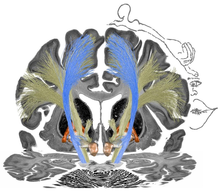 Die Stimulation der blauen Trakte ging mit einer Verbesserung der Symptomatik...