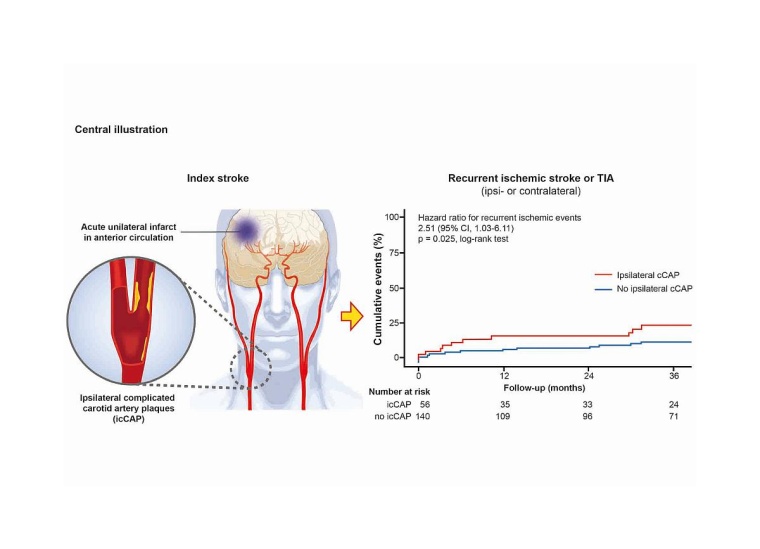 Komplizierte Plaques in der Halsschlagader als Risikofaktor für einen erneuten...