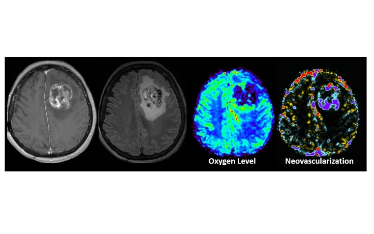 Physiologische und fortgeschrittene Magentresonanztomographie erlauben in...