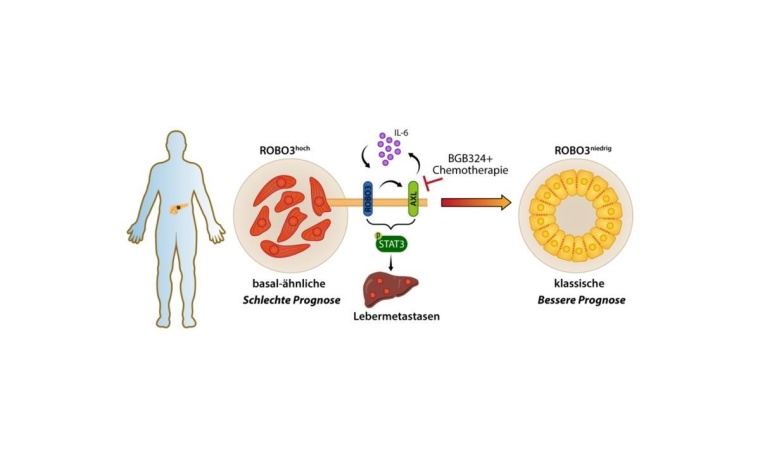 ROBO3-vermittelte Subtypenspezifität bei Bauchspeicheldrüsenkrebs. Quelle:...