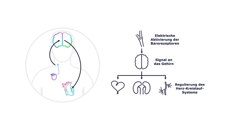 Bei der BAT erfolgt sowohl eine afferente als auch efferente nervale...