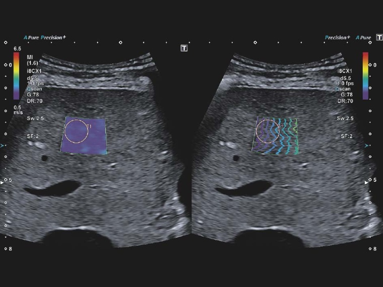 Darstellung der mittels Push-Impuls generierten Scherwellen im „Propagation...