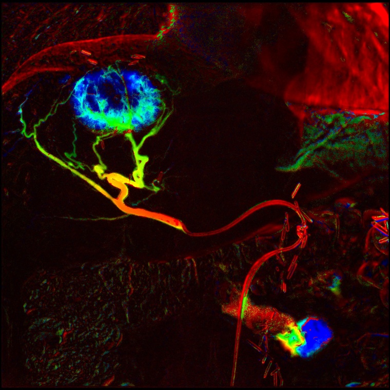 Metastasen unter lokaler intraarterieller Chemoembolisation. Foto: Prof. Dr....
