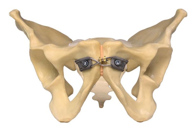 Unfallchirurgen des Uniklinikums Würzburg haben mit internen und externen...