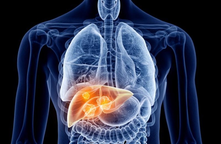 Lebermetastasen, Foto: AdobeStock