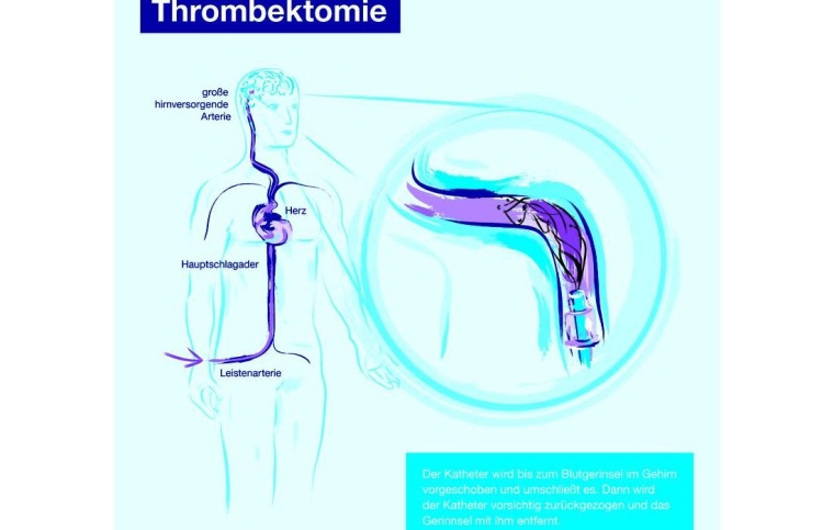 Infographik Thrombektomie, Foto: DGN/Agentur Adverb