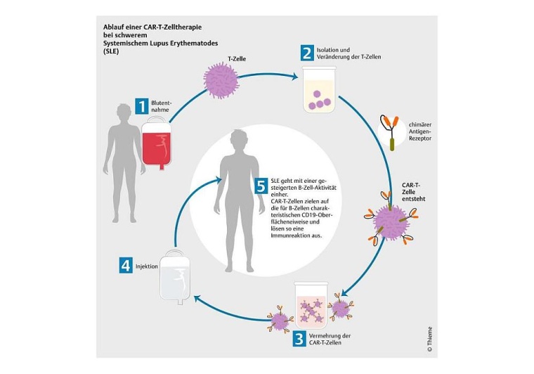 Ablauf einer CAR-T-Zelltherapie bei schwerem Systemischem Lupus Erythematodes,...