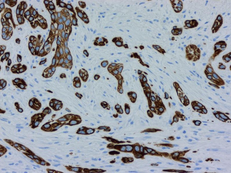 Keratin-7-Färbung eines Bauchspeicheldrüsentumors, Foto: Bosch Health Campus