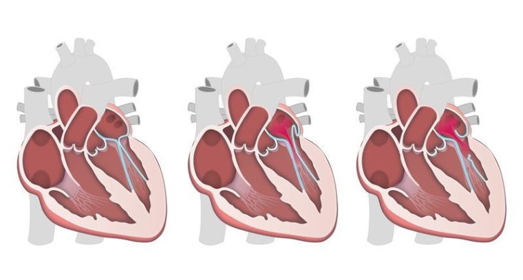 Mitralklappenprolaps (Mitte und rechts) im Vergleich zu einer gesunden Klappe....
