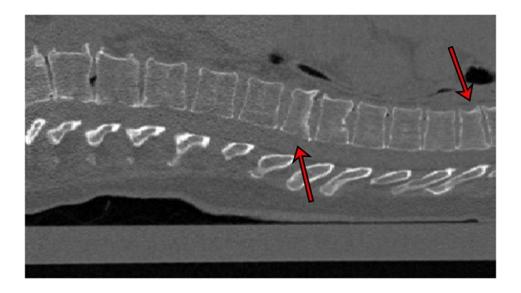 2D-Schnittbild einer CT-Aufnahme auf der zwei Frakturen zu sehen sind. Sie...