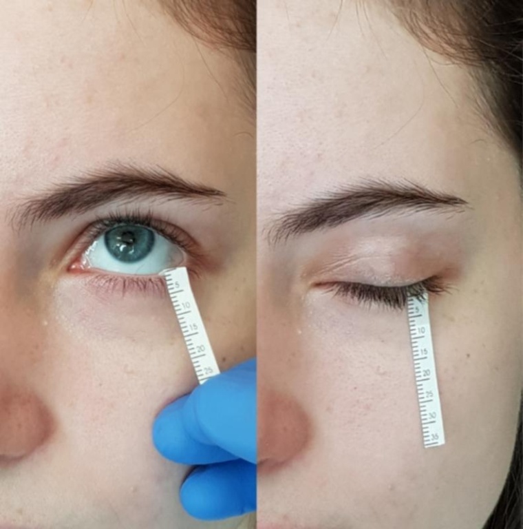 Sammeln von Tränenflüssigkeit mit einem Papierstreifen, sogenannter...