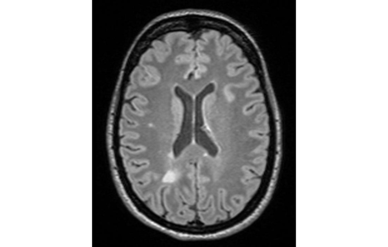 MRT-Bild des Gehirns einer Patientin mit Multipler Sklerose. Die...