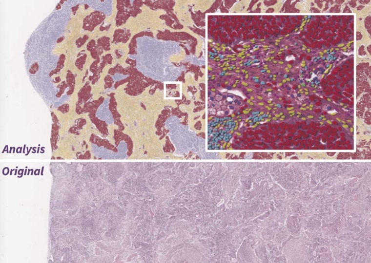 KI-basierte Analyse eines Hämatoxylin-Eosin-gefärbten histologischen...