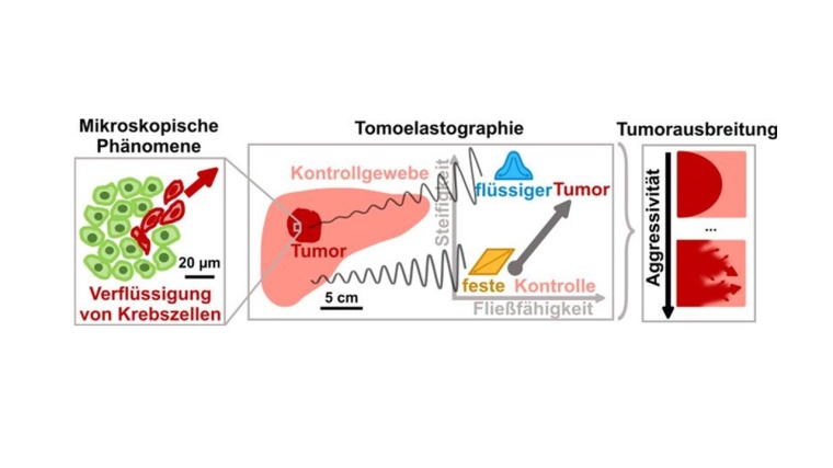 Tumor-assoziiert mikroskopische Effekte wie die Verflüssigung oder erhöhte...