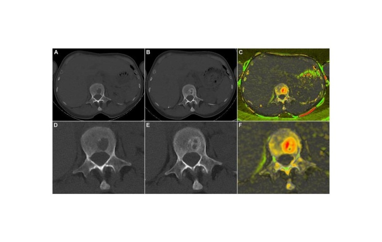 Darstellung des Therapieansprechens bei einer 62-jährigen Patientin mit...